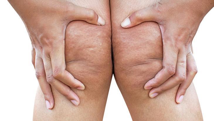 lipodem kadinlarin sessiz cigligi neden kilo veremiyorum diyenler icin cevap pTXQkOAN.jpg